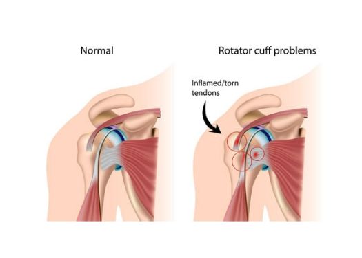 shoulder rotator cuff surgery